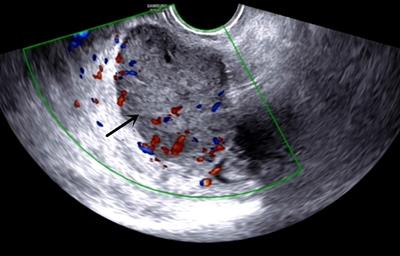 Deep Infiltrating Endometriosis Malignant Invasion of Cervical Wall and Rectal Wall With Lynch Syndrome： A Rare Case Report and Review of Literature